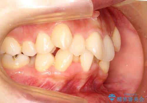 【八重歯・重度のがたつきでお悩みの方必見】抜歯矯正症例(審美ワイヤー矯正)の治療前