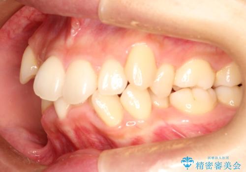 【八重歯・重度のがたつきでお悩みの方必見】抜歯矯正症例(審美ワイヤー矯正)の治療前