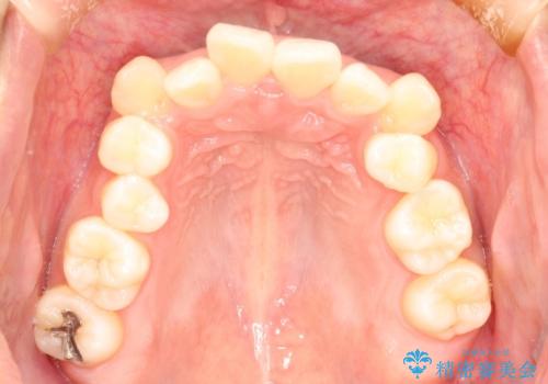 【八重歯・重度のがたつきでお悩みの方必見】抜歯矯正症例(審美ワイヤー矯正)の治療前