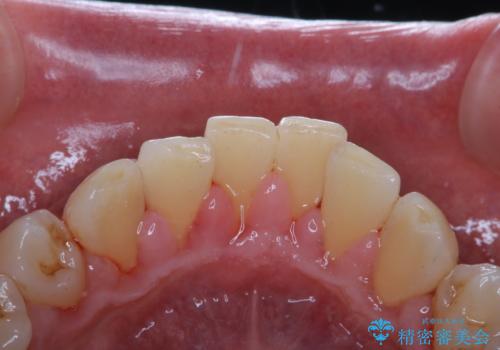 友人の結婚式前に歯を綺麗にしたいの治療後
