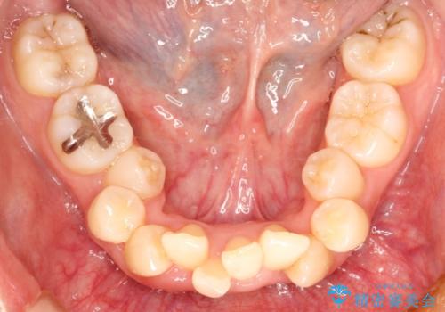 【八重歯・重度のがたつきでお悩みの方必見】抜歯矯正症例(審美ワイヤー矯正)の治療前