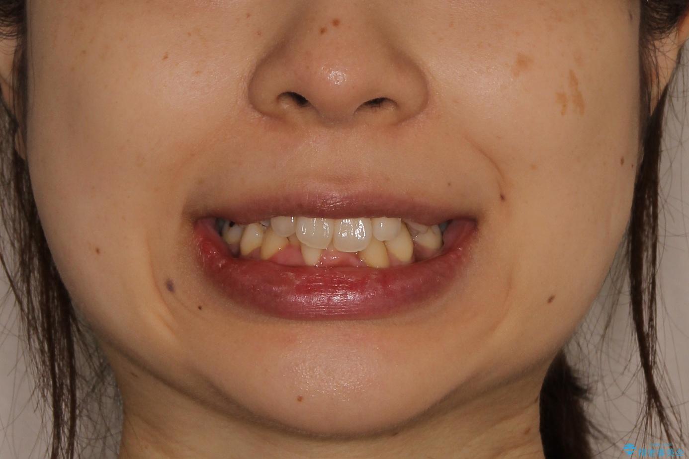 【八重歯・重度のがたつきでお悩みの方必見】抜歯矯正症例(審美ワイヤー矯正)の治療前(顔貌)