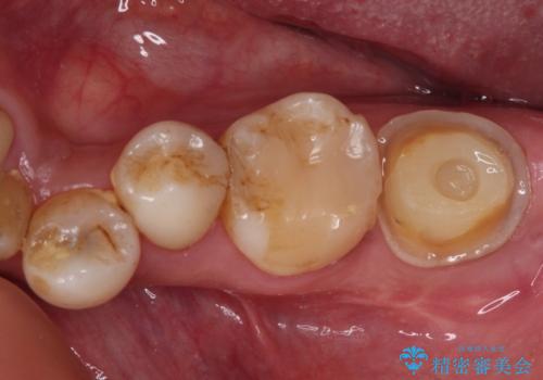 セラミックは無理と言われた奥歯　フルジルコニアクラウンによる補綴治療の症例 治療前
