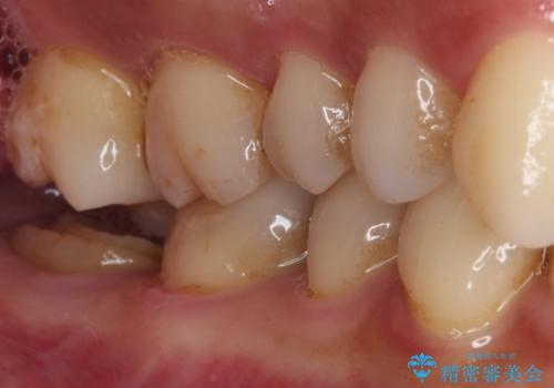 セラミックは無理と言われた奥歯 フルジルコニアクラウンによる補綴治療の治療前
