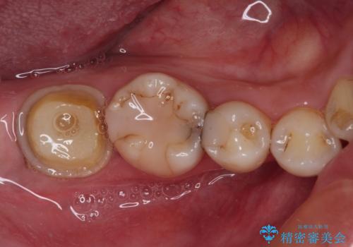 セラミックは無理と言われた奥歯 フルジルコニアクラウンによる補綴治療の治療前