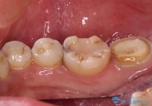 セラミックは無理と言われた奥歯 フルジルコニアクラウンによる補綴治療の治療前