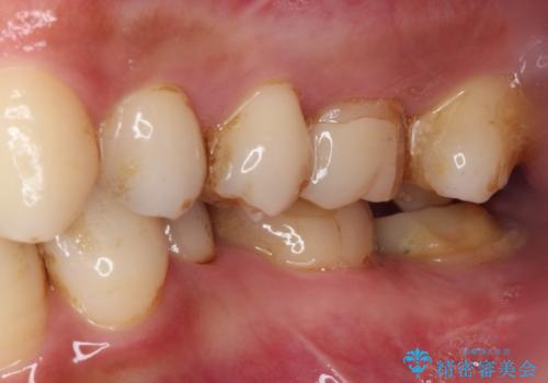 セラミックは無理と言われた奥歯 フルジルコニアクラウンによる補綴治療の治療前