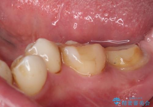 セラミックは無理と言われた奥歯 フルジルコニアクラウンによる補綴治療の治療前