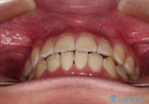 非抜歯ワイヤー装置による、短期間での矯正治療の治療後