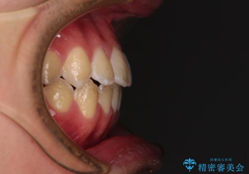 非抜歯ワイヤー装置による、短期間での矯正治療の治療後