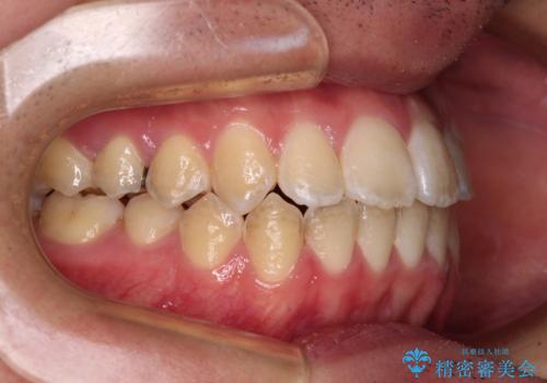 非抜歯ワイヤー装置による、短期間での矯正治療の治療後