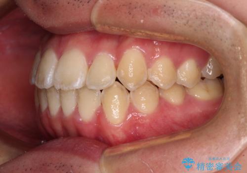 非抜歯ワイヤー装置による、短期間での矯正治療の治療後