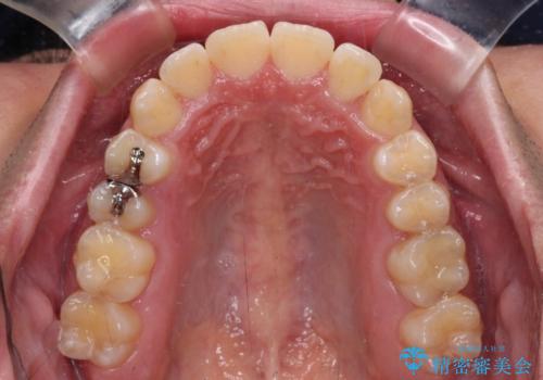 非抜歯ワイヤー装置による、短期間での矯正治療の治療後