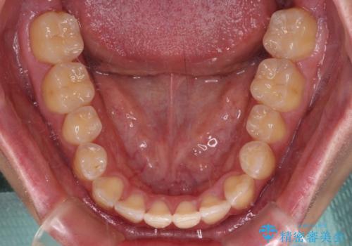 非抜歯ワイヤー装置による、短期間での矯正治療の治療後