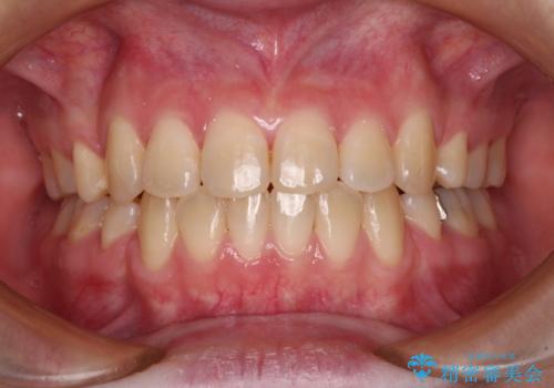 上下の出っ歯を治したい ワイヤー装置による抜歯矯正の症例 治療後