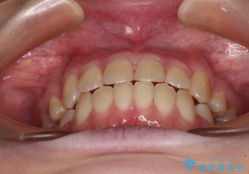 上下の出っ歯を治したい ワイヤー装置による抜歯矯正の治療後