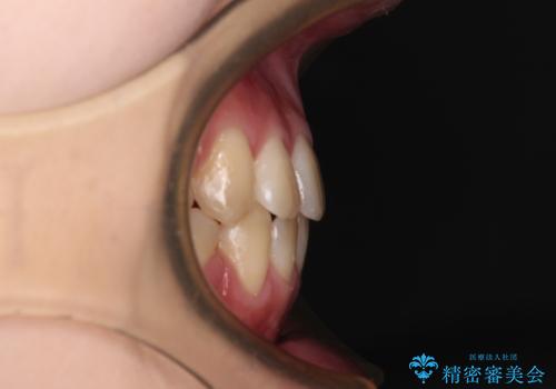 上下の出っ歯を治したい　ワイヤー装置による抜歯矯正の治療後