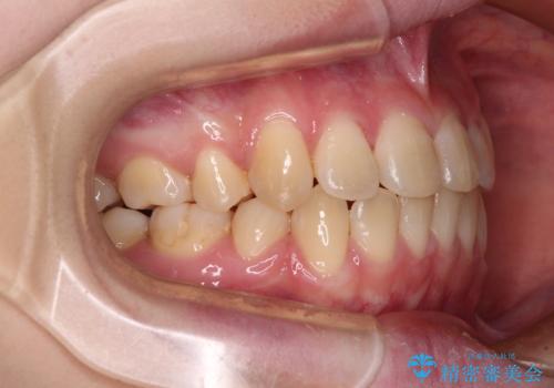 上下の出っ歯を治したい ワイヤー装置による抜歯矯正の治療後