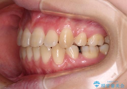 上下の出っ歯を治したい ワイヤー装置による抜歯矯正の治療後