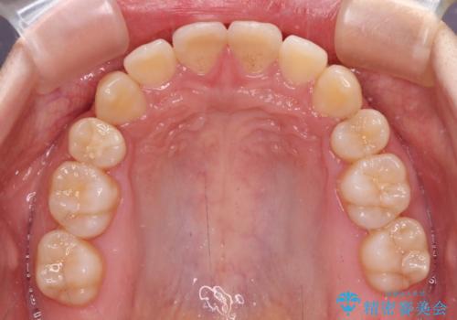 上下の出っ歯を治したい ワイヤー装置による抜歯矯正の治療後