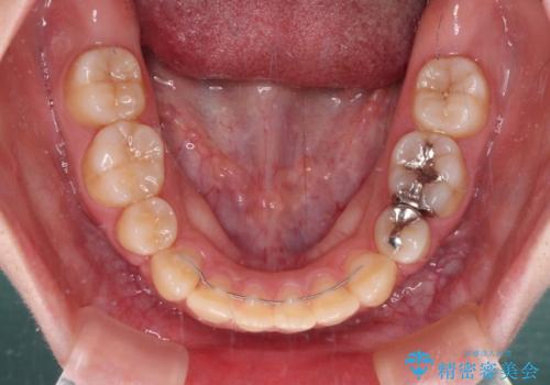 上下の出っ歯を治したい　ワイヤー装置による抜歯矯正の治療後