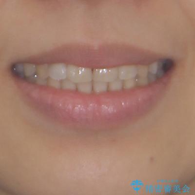 後戻りの再矯正治療と欠損部の補綴治療の治療後(顔貌)