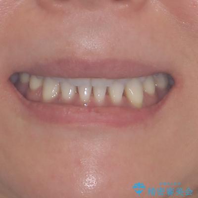 抜歯矯正の後戻りをインビザライン・ライトで解消の治療後(顔貌)
