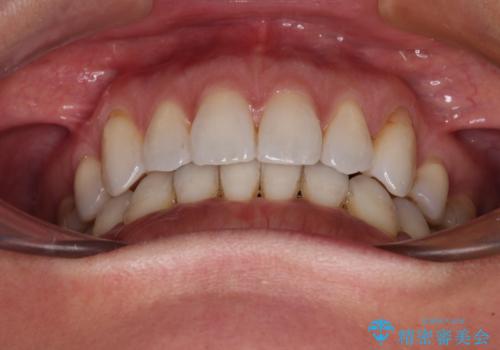 抜歯矯正の後戻りをインビザライン・ライトで解消の治療後