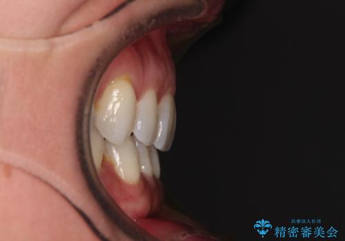 抜歯矯正の後戻りをインビザライン・ライトで解消の治療後