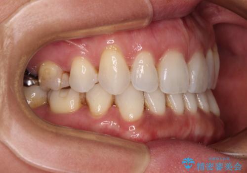 抜歯矯正の後戻りをインビザライン・ライトで解消の治療後