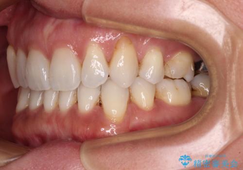 抜歯矯正の後戻りをインビザライン・ライトで解消の治療後