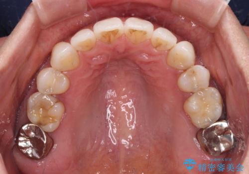 抜歯矯正の後戻りをインビザライン・ライトで解消の治療後