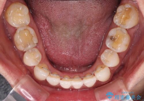 抜歯矯正の後戻りをインビザライン・ライトで解消の治療後