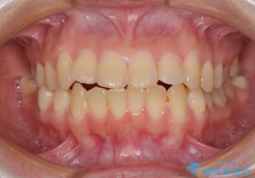 上下の出っ歯を治したい ワイヤー装置による抜歯矯正の症例 治療前