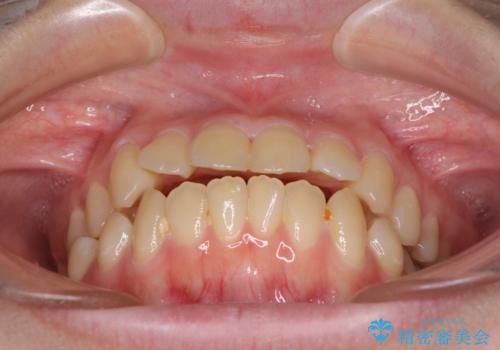 上下の出っ歯を治したい ワイヤー装置による抜歯矯正の治療前