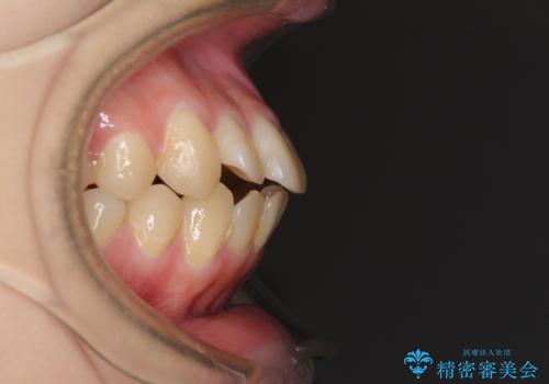 上下の出っ歯を治したい　ワイヤー装置による抜歯矯正の治療前