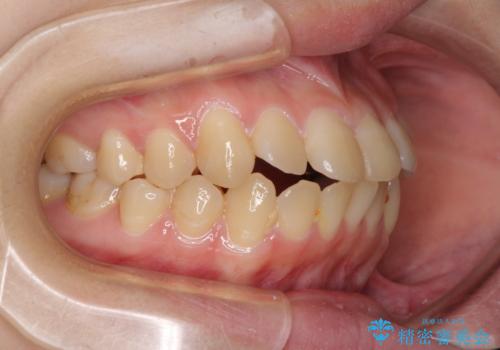 上下の出っ歯を治したい ワイヤー装置による抜歯矯正の治療前