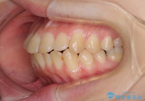上下の出っ歯を治したい　ワイヤー装置による抜歯矯正の治療前