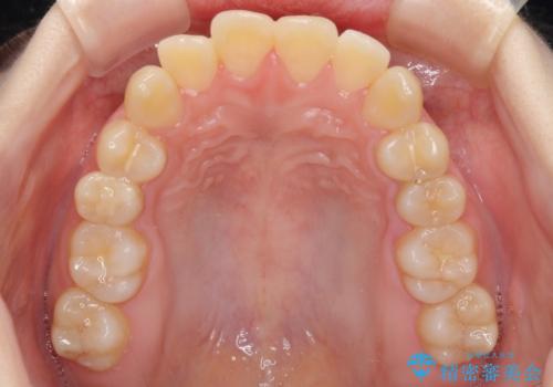 上下の出っ歯を治したい ワイヤー装置による抜歯矯正の治療前