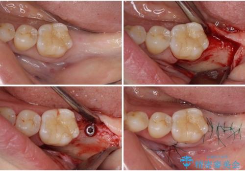 後戻りの再矯正治療と欠損部の補綴治療の治療中