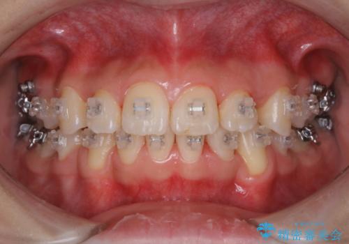 ワイヤー矯正中は1.2カ月に1回はクリーニング(PMTC)の治療後