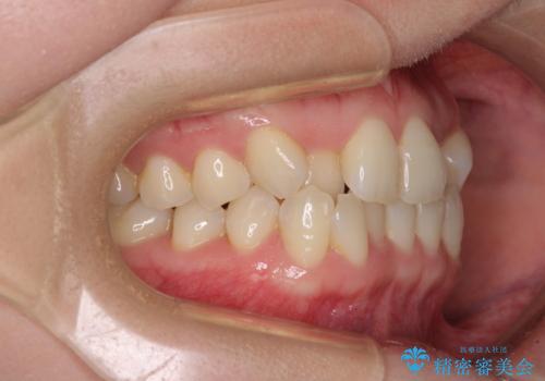 ワイヤー矯正で楽して治療　前歯のデコボコを短期間で改善の治療前