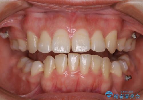 インビザラインの矯正治療中のクリーニング(PMTC)