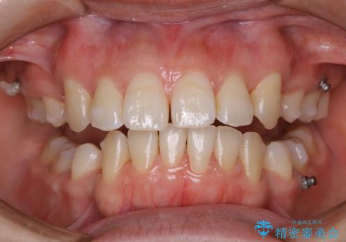 インビザラインの矯正治療中のクリーニング(PMTC)の症例 治療後