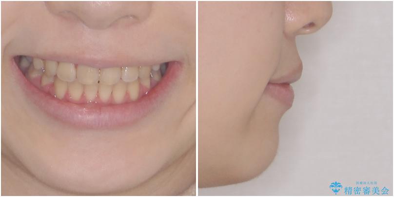 上下の出っ歯を治したい ワイヤー装置による抜歯矯正の治療後(顔貌)