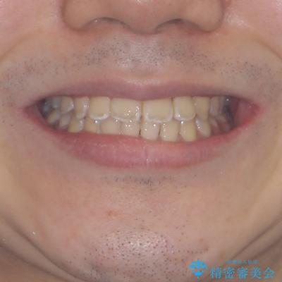 非抜歯ワイヤー装置による、短期間での矯正治療の治療後(顔貌)