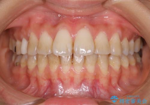 新学期に向けて歯をきれいにしたいの治療前