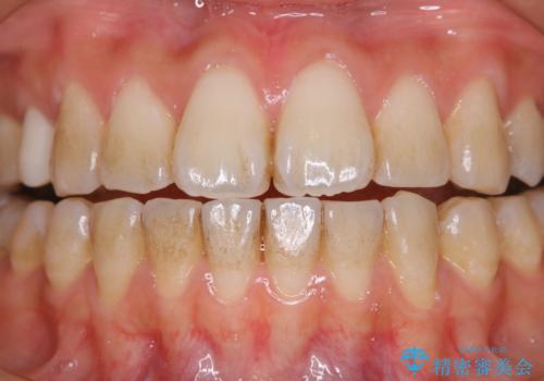 新学期に向けて歯をきれいにしたいの治療前