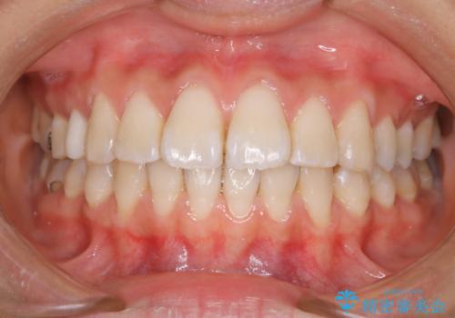 新学期に向けて歯をきれいにしたいの治療後