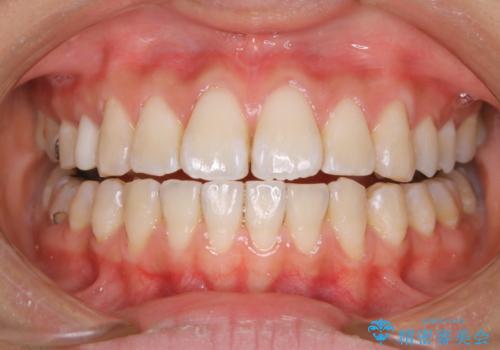 新学期に向けて歯をきれいにしたいの症例 治療後